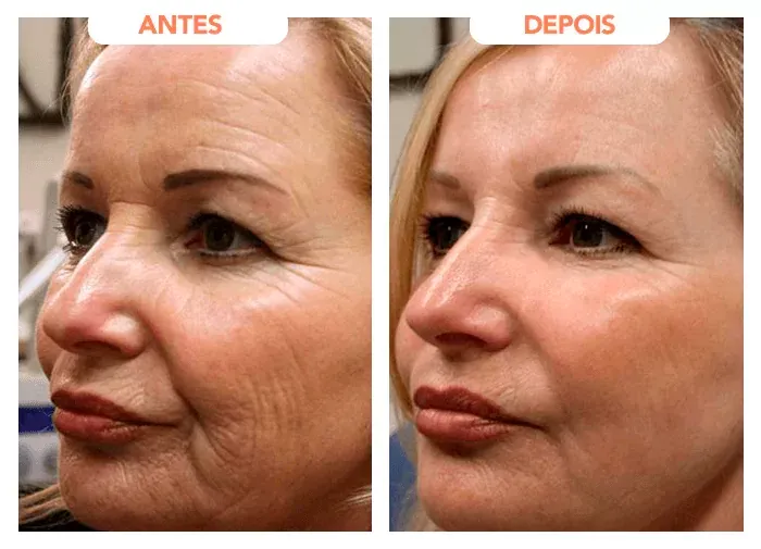 Segundo relato de cliente sobre o Trans Resveratrol